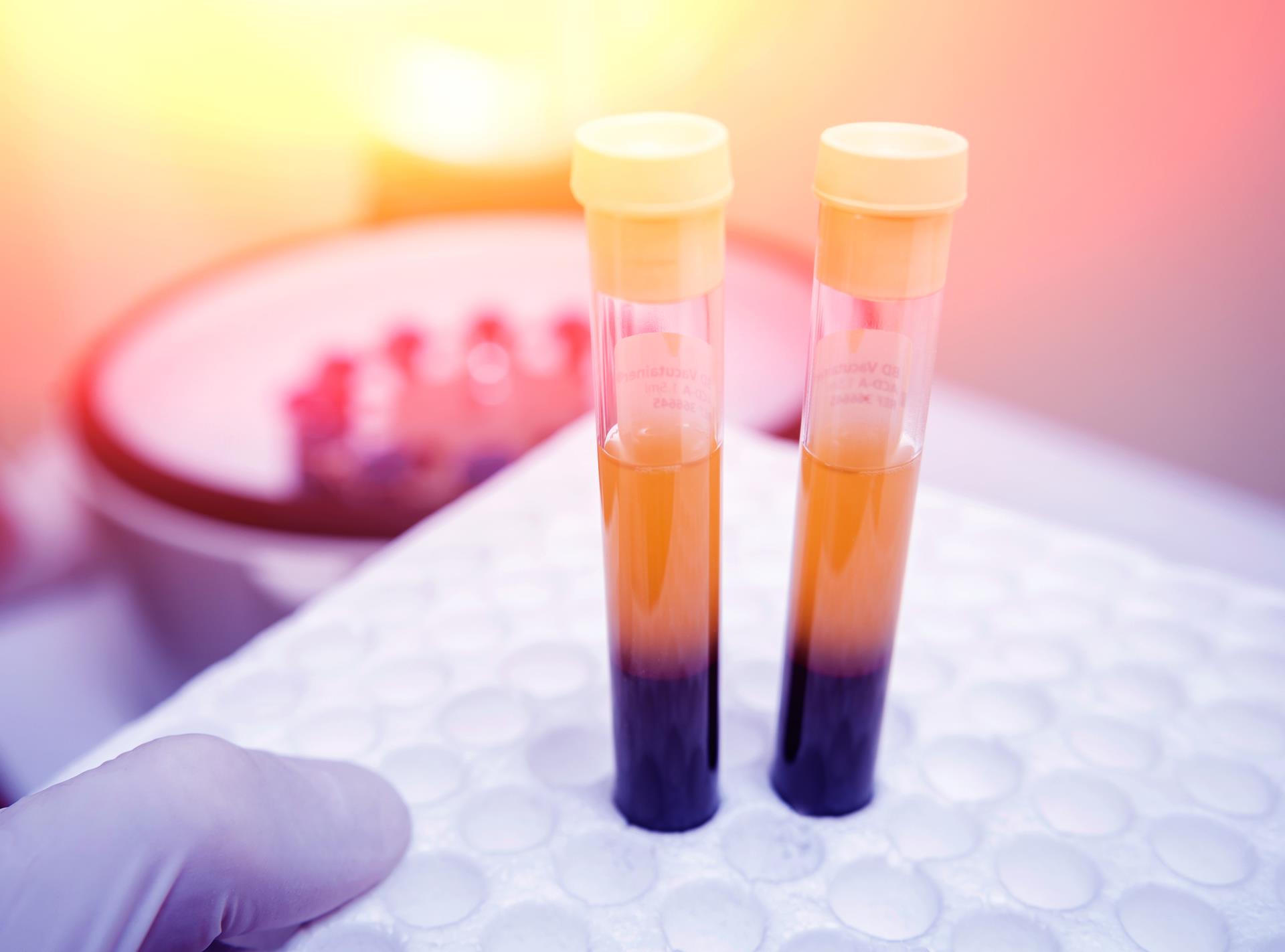 PRP (Platelet-Rich Plasma)